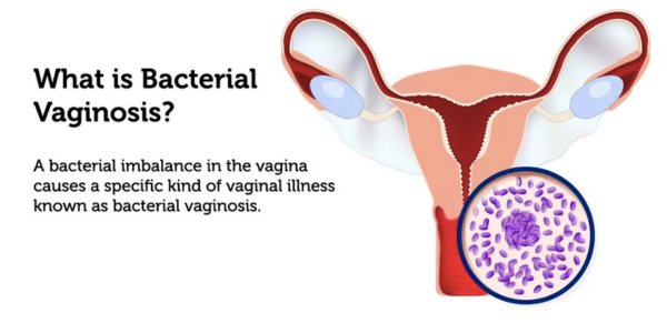 What is Bacterial Vaginosis