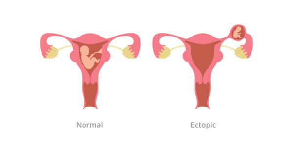 What is Ectopic Pregnancy