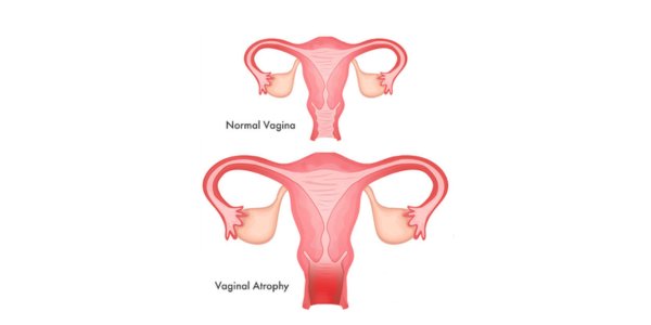 What is Vaginal Atrophy
