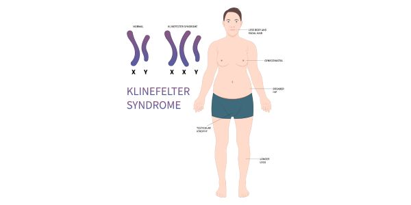 What isKlinefelter’s Syndrome
