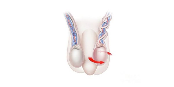 What is Testicular Torsion